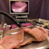 La dissection sous muqueuse : une révolution endoscopique au cœur des innovations thérapeutiques